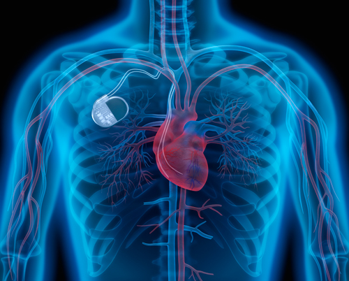 TIPE Pacemakers